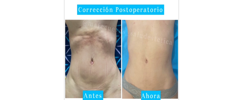 Curso Postoperatorio Sin Rastro De Fibrosis